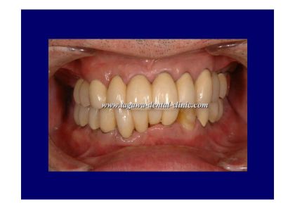 歯周病治療に関するイメージ写真（治療説明）