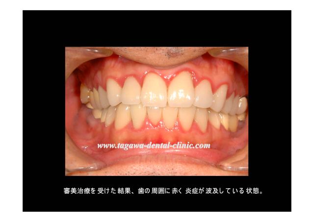 生物学的幅径の侵襲を示したイメージ図