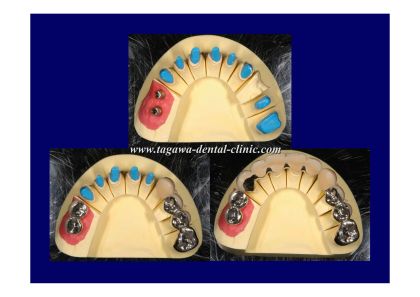 インプラント印象で作成されたマスターモデル