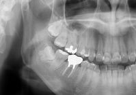 初診時のレントゲンイメージ写真