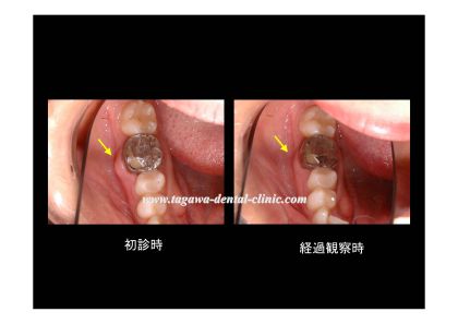 治療後の咬合バランスのイメージ写真