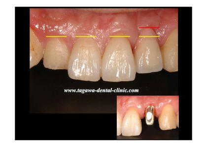 審美インプラント治療に関連する骨保存のイメージ