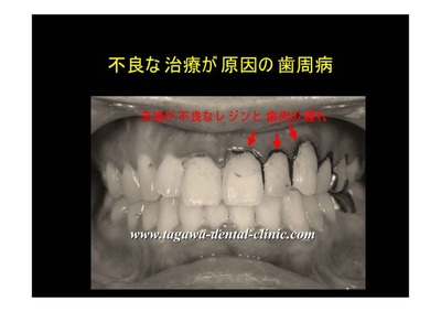 歯と詰め物の境目に汚れがつきやすい状態を示すイメージ図