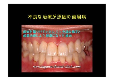 詰め物の形態を整え直した後の歯周状態のイメージ図