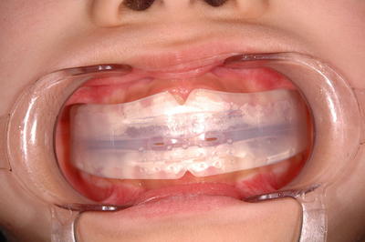 プレトレーニング装置（口腔内装着時）