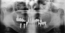 Linkow_implant.jpg