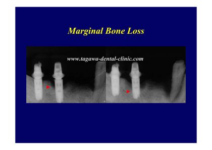 bone-loss.jpg