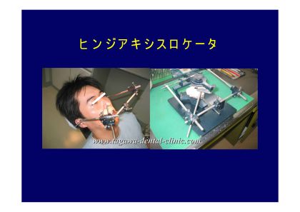 咬み合わせ分析に用いる器具の例