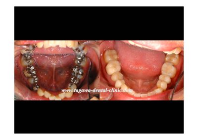 ダイレクトボンディング治療前の奥歯の状態