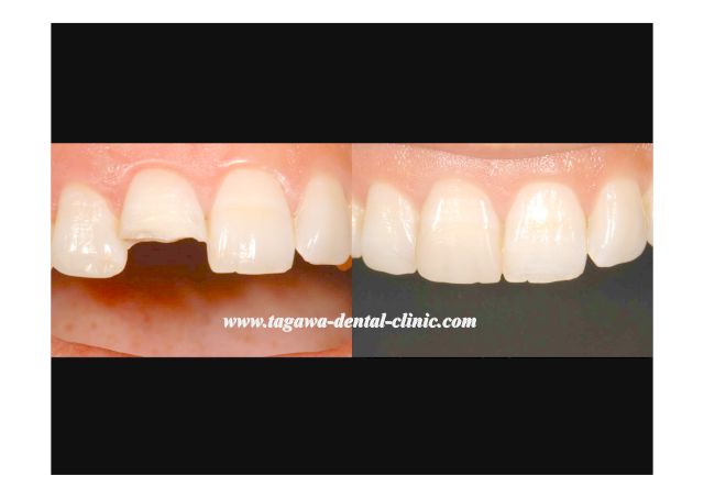 転倒により前歯が破折した女性の症例（施術前）