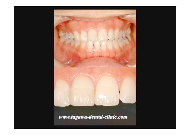 ダイレクトボンディングで前歯破折を復元した症例の施術後