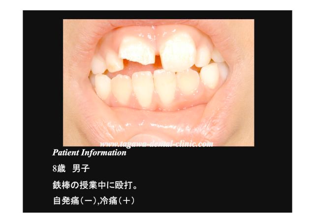 鉄棒で前歯を強打し欠けた状態の症例写真