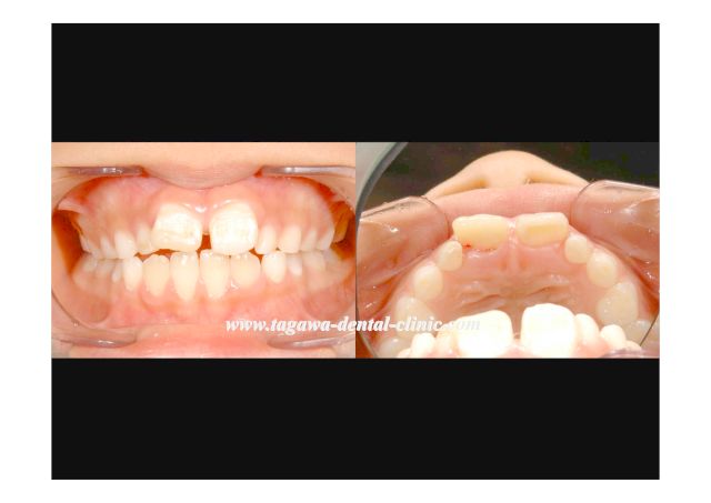 簡易樹脂による一次的な前歯形態回復処置
