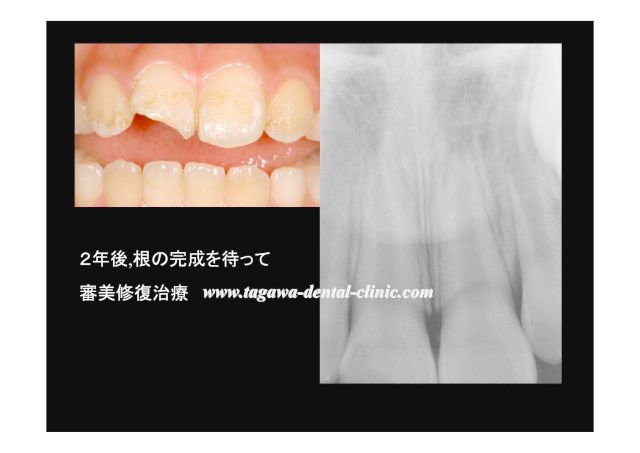 ダイレクトボンディングで前歯の形態を回復した症例