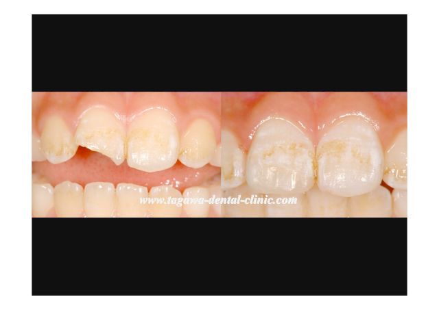 前歯破折のダイレクトボンディング術後の状態