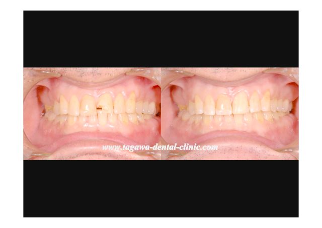 ピスタチオの殻を噛んで前歯が欠けた症例の施術前後