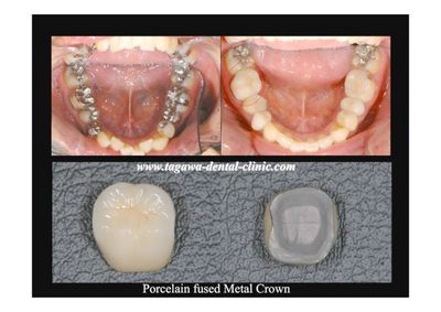 PFM(メタルボンド)治療の参考画像