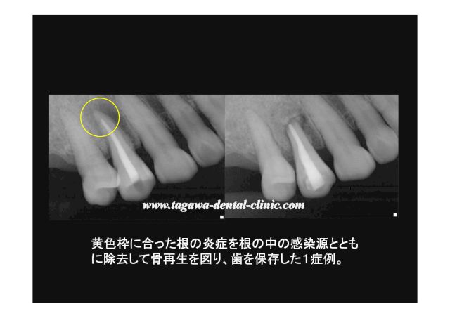 根管治療の説明用イメージ写真(歯の内部構造の模式図)