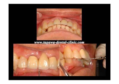 咬合状態のイメージ写真1