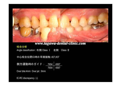 咬合状態のイメージ写真2