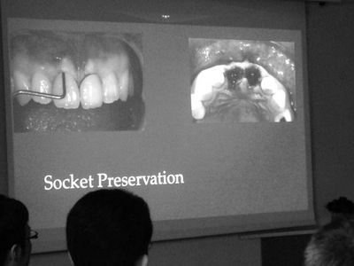 歯周組織再建の概念イメージ写真