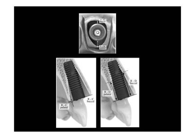 抜歯後の骨吸収による顎の形態変化のイメージ図