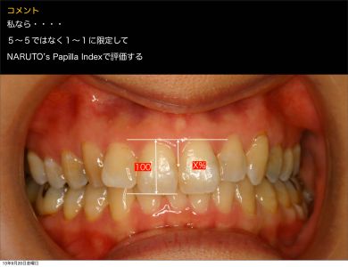 インプラント審美治療に関する論文スライド3