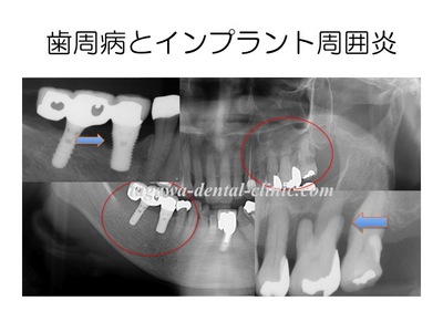 歯周病とインプラントの関係を示すイメージ写真