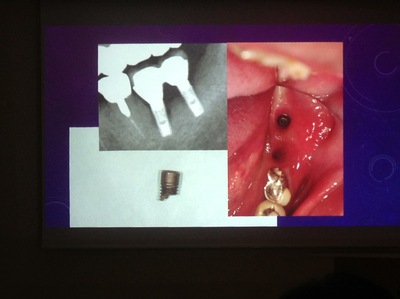 インプラント除去と再埋入についてのスライド