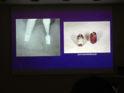 インプラント除去と再埋入についてのスライド