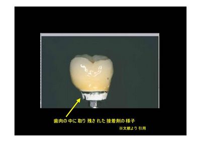 インプラント周囲に残留した接着剤(セメント)の臨床画像