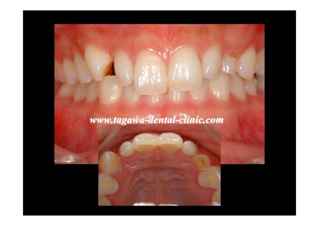 ダイレクトボンディング施術前の前歯の状態