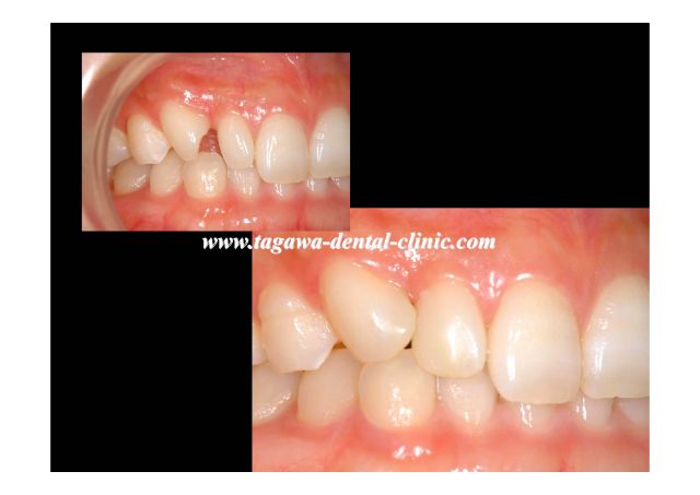 ダイレクトボンディング前後比較（右側方面観）