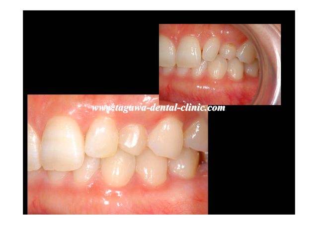 ダイレクトボンディング前後比較（左側方面観）