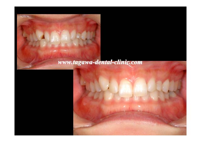 ダイレクトボンディング施術後の前歯正面観