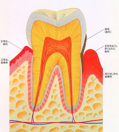 歯周病の進行イメージ図(歯肉炎と歯周炎の違い)