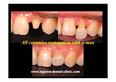 オールセラミッククラウン（e-max・ジルコニア）のイメージ画像