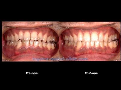 PMTCの施術をイメージした歯面清掃の写真