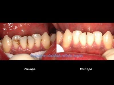歯科衛生士によるクリーニング作業のイメージ写真