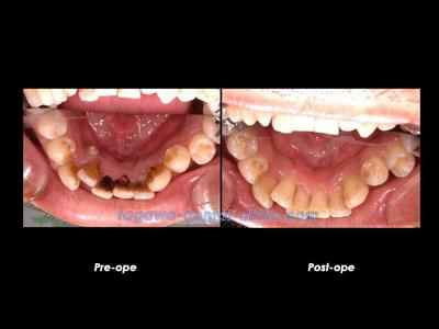 歯の表面を清掃している様子のイメージ