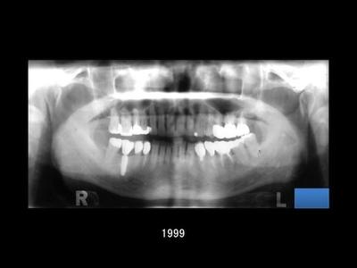 歯周治療後の口腔内写真(治療当時の状態)