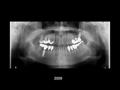 インプラント治療後のレントゲン・口腔内写真