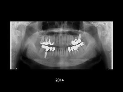 長期経過観察における口腔内の状態