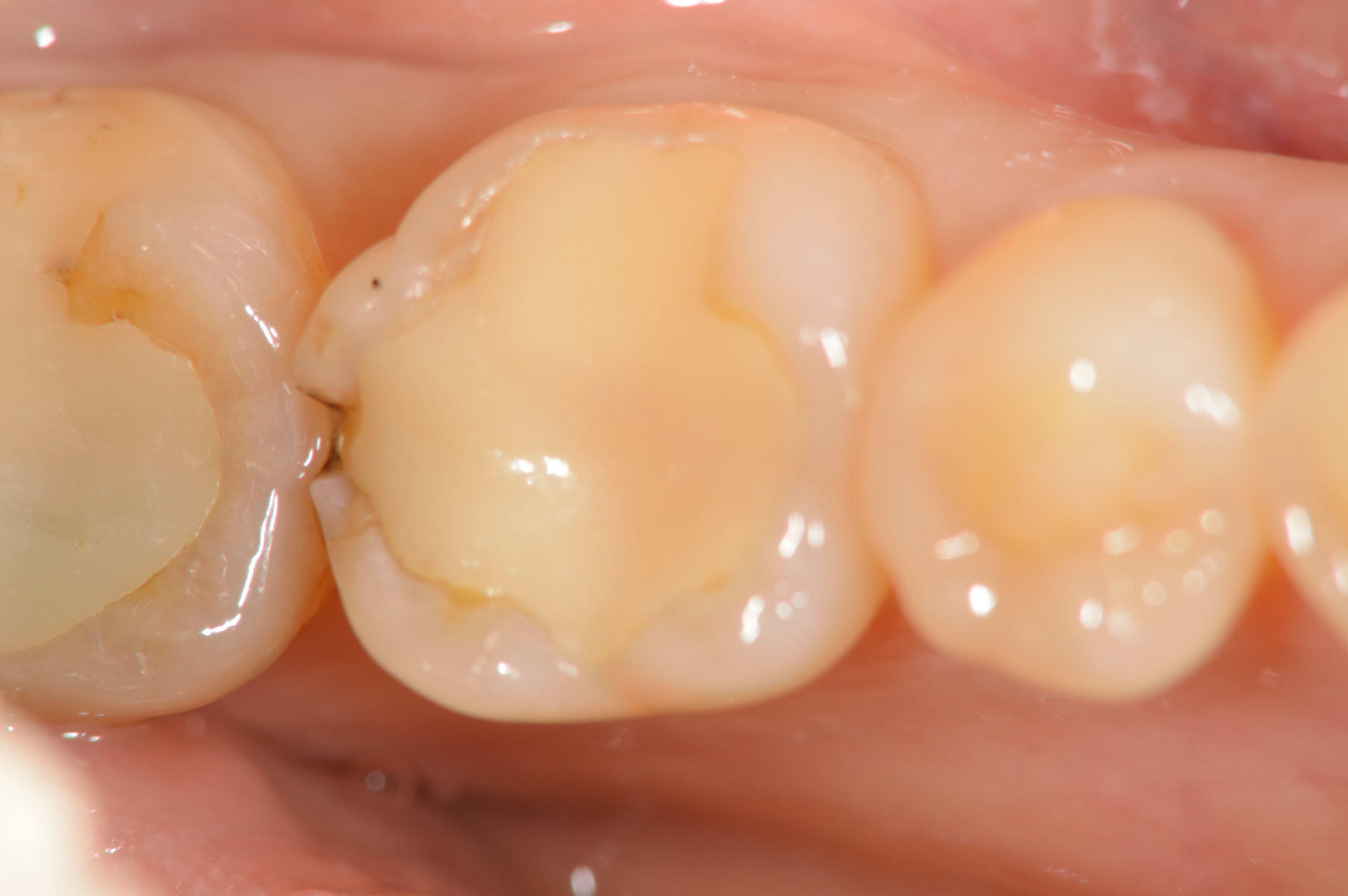 左下の歯が欠けた状態(治療前)
