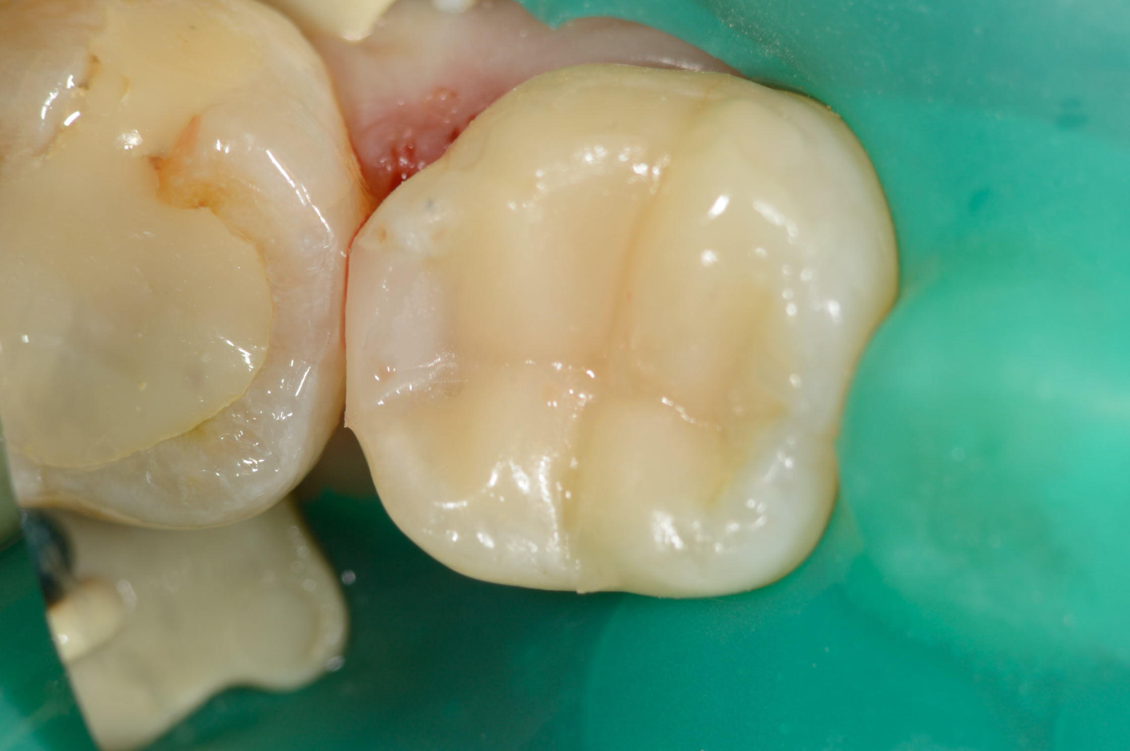 ダイレクトボンディングによる修復(治療後)