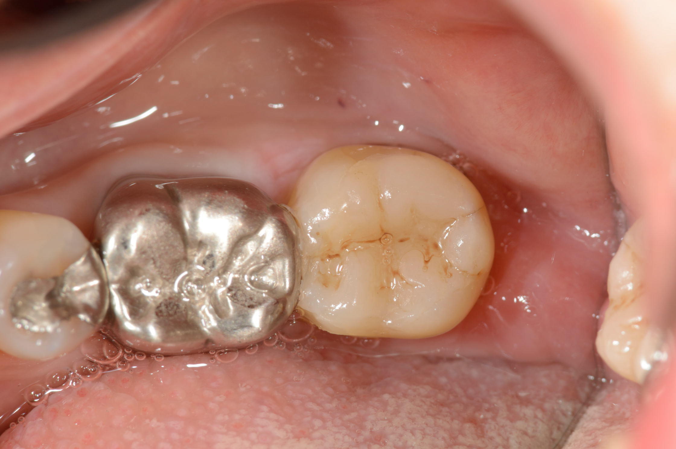 ダイレクトボンディング修復後の自然な仕上がり