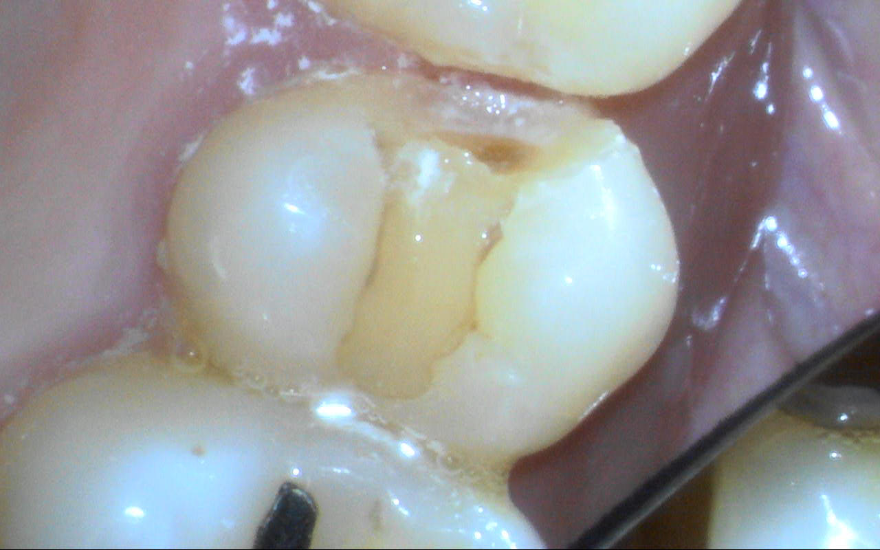 詰め物にヒビが入っている状態を拡大した口腔内写真
