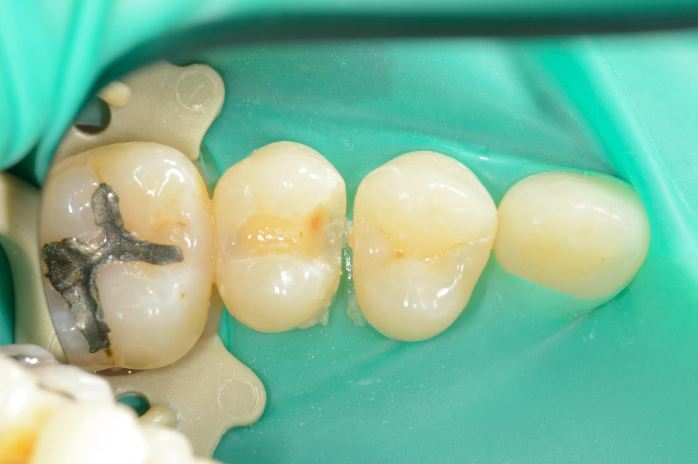 割れた詰め物が確認できるマイクロスコープ画像