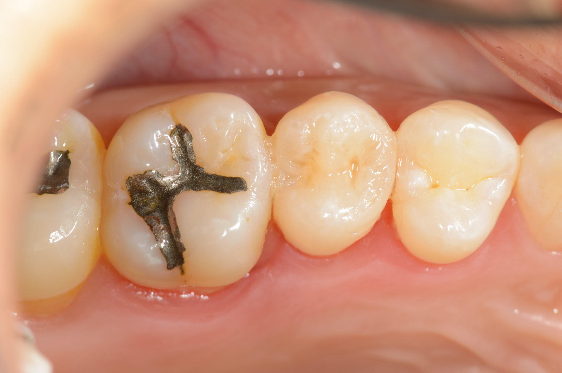 ダイレクトボンディングで修復された後の自然な仕上がり