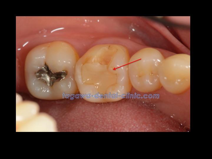 ダイレクトボンディング治療前の歯の状態